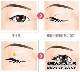 微创双眼皮的术后恢复自然吗