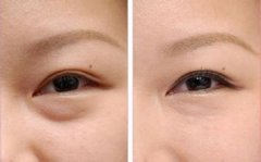 玻尿酸去眼袋纹应该注意什么？