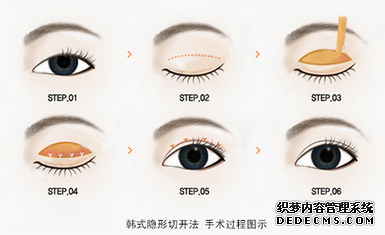 双眼皮手术过程图文介绍