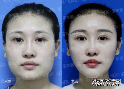 下颌角磨骨多少钱