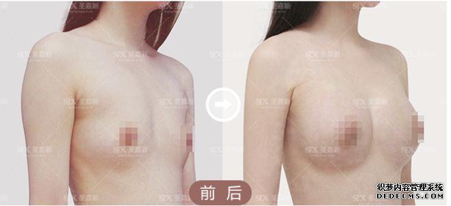 自体脂肪隆胸