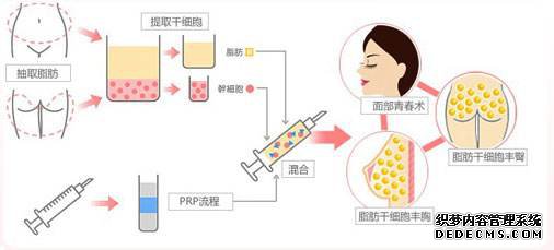 自体脂肪丰胸效果