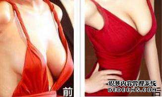 乳房下垂矫正方法