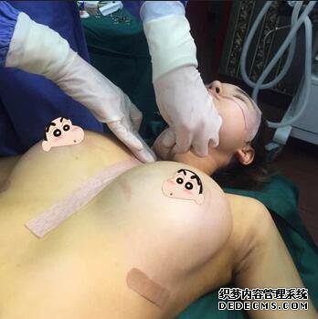 上海余天成自体脂肪隆胸70天恢复经历
