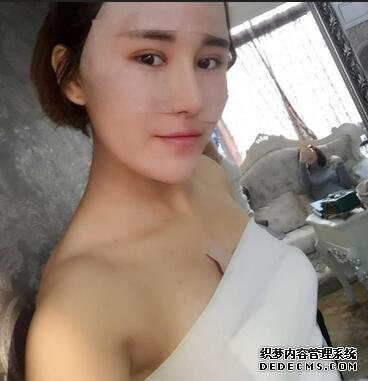 上海余天成自体脂肪隆胸70天恢复经历